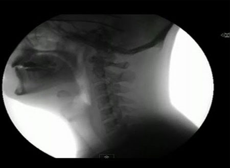 فيديو.. من خلال &laquo;أشعة X&raquo; مقطع يصور الأمعاء أثناء تناوله الطعام