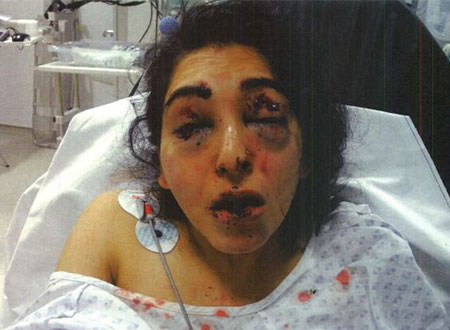 رجل من السيخ يفقأ عيني ابنته لأنها تعرف شابا مسلما.. صور