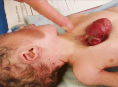 ولادة طفل يمني قلبه خارج القفص الصدري 