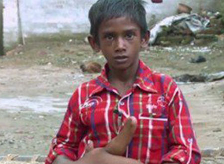 فيديو وصور.. مرض نادر يتسبب فى زيادة وزن يد طفل هندى إلى 13 كيلو