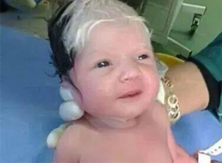 ولادة طفل سوري بشعر &laquo;شايب&raquo;
