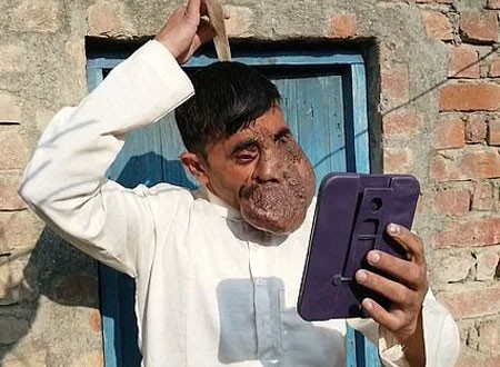 قرية هندية تعبد رجلاً بسبب ورم هائل في وجهه .. صور
